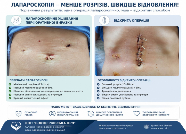 Лапароскопія — сучасний підхід до хірургічного лікування