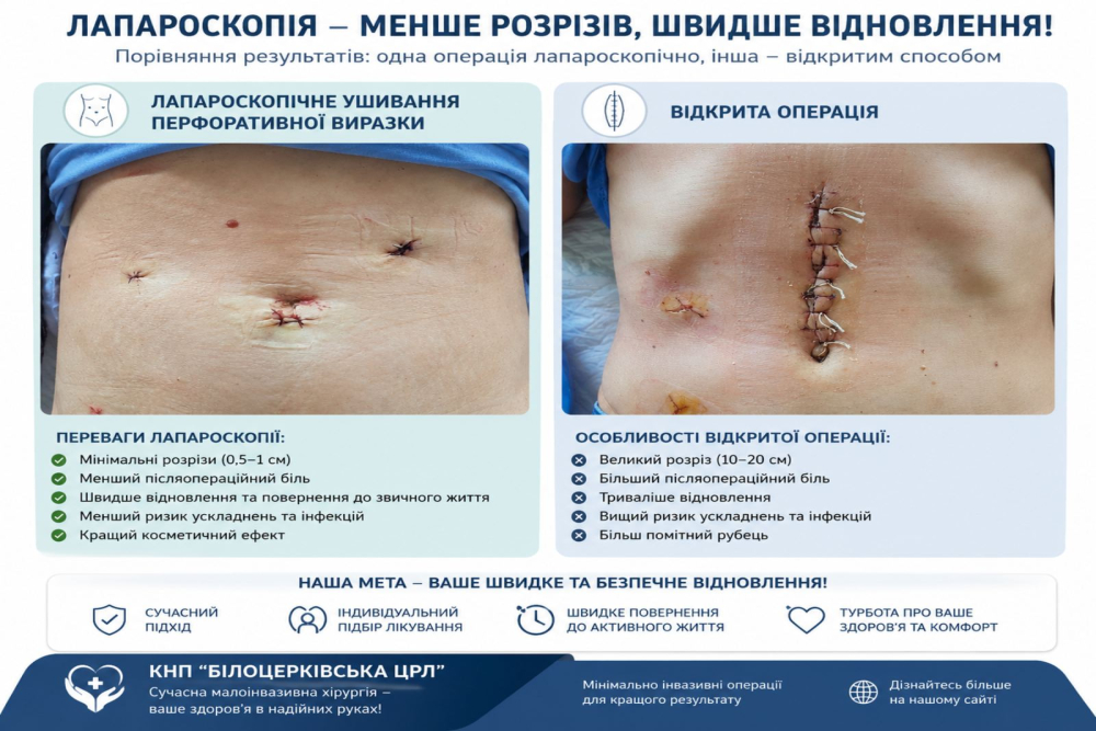 Лапароскопія — сучасний підхід до хірургічного лікування
